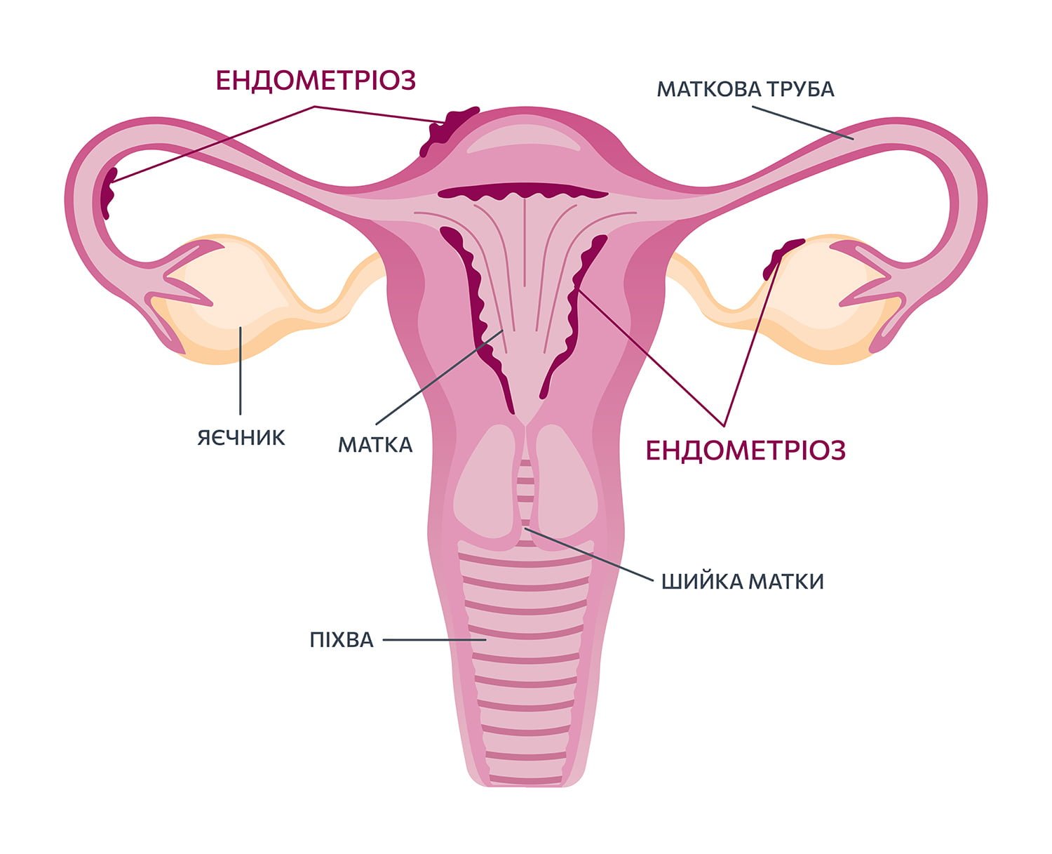 Endometrioz 2 01